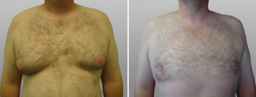 Gynaecomastia patient 02, image 04, front view, before & after