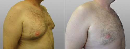 Patient 02 before and after male breast reduction, image 05, angle view