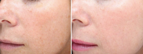Before and after Halo laser treatment, facial area, angle view, image 02