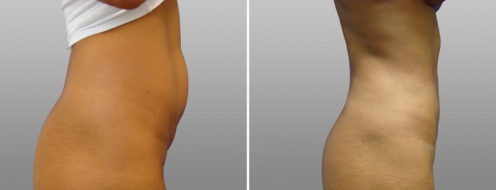 Patient Liposculpture (Lipoplasty) before and after images, at Form & Face clinic in Sydney, image 02