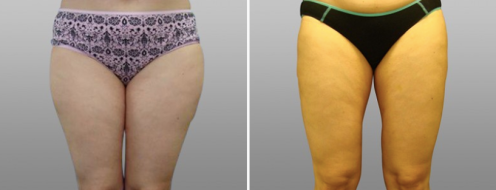 Thigh Lift (Thigh Lipectomy), before and after images, patient 11, image 10