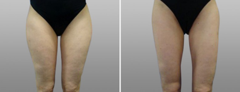 Patient before and after liposuction to thighs, patient 04, image 02