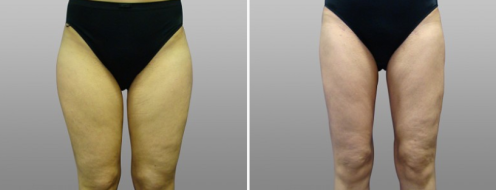 Thigh Lift (Thigh Lipectomy) images, patient 05, before and after procedure, image 04