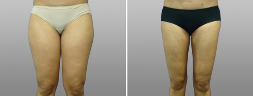 Thigh Lift (Thigh Lipectomy) before and after images, patient 06, image 04