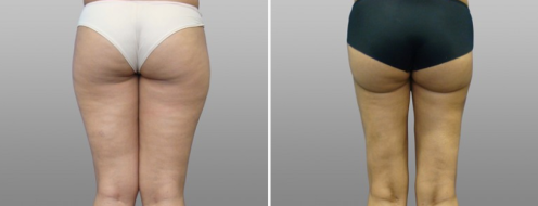 Patient before and after liposuction to thighs, image 05