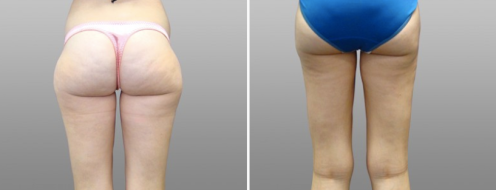 Thigh Lift (Thigh Lipectomy) before and after images, patient 07, image 06