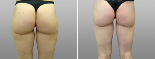 Patient 08, liposuction to thighs, image 08