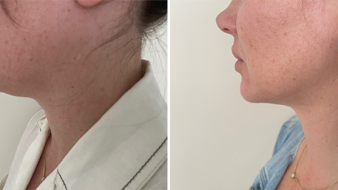 Liposuction To Chin Patient 1