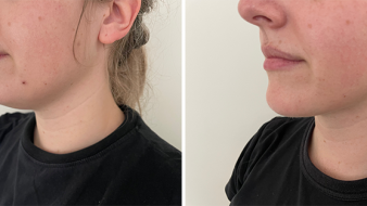 Liposuction To Chin Patient  G 1