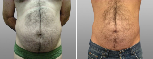 Male Liposculpture before and after images, patient 01, image 01