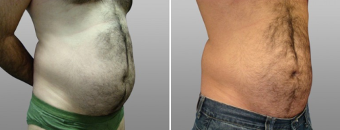 Patient before and after male liposuction, patient 02, image 02