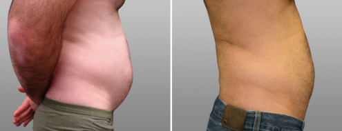 Liposuction for men, patient 03, before and after photo, side view