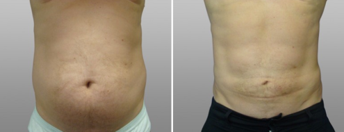 Male liposuction gallery, image 06, before & after, front view