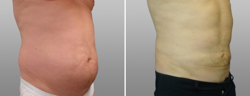 Male liposuction patient 07, image 07, angle view