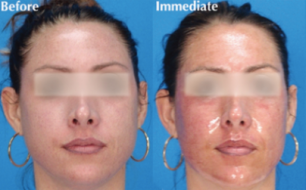 Patient before & after microlaser peel treatment, image 06