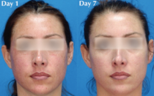 Mesoestetic Peel images, image 07, front view
