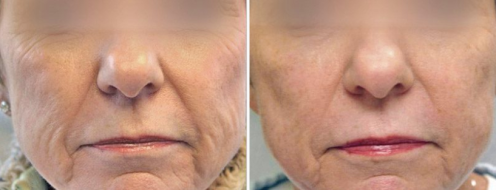 Laser Skin Rejuvenation before and after images, image 01, front view
