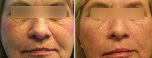 Laser Skin Rejuvenation before and after images, image 02, face - front view