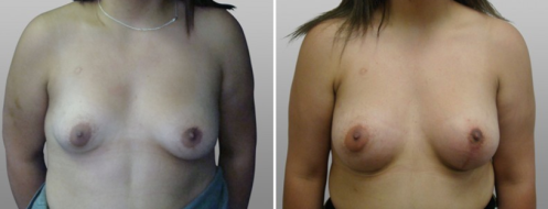Tubular breasts correction images, image 12, front view