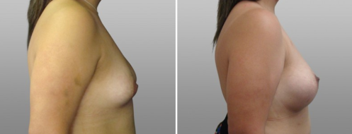Tuberous breasts before and after, patient 07, side view, surgery results