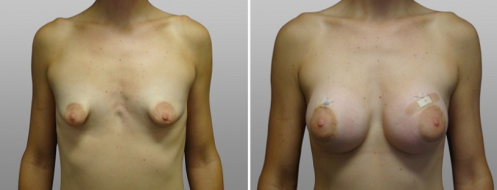 Patient before and after tuberous breasts correction, image 14, front view