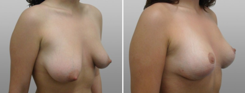Patient 01, tuberous breasts correction, before and after photo 02, angle view