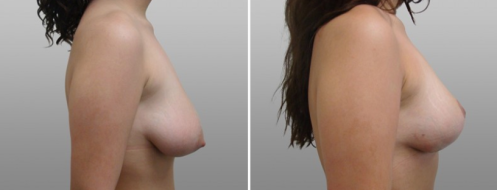 Tuberous breasts patient 01, before and after photo 03, side view