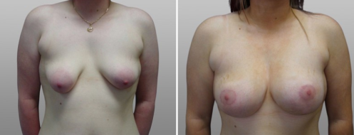 Tuberous breasts before and after, front view, image 04, patient 02
