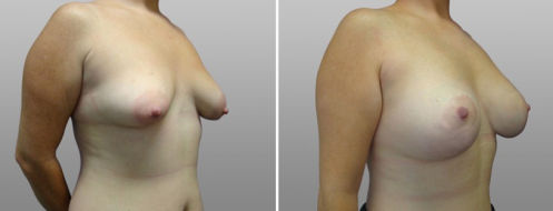 Patient before and after tuberous breasts correction, image 05, angle view