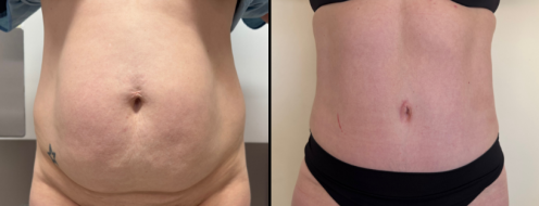 Tummy Tuck Photos 7 Abdominoplasty (Tummy Tuck) before and after images, front view, surgery results, post-op 19 months, client 47