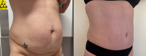 Tummy Tuck Photos 2 Abdominoplasty (Tummy Tuck) before and after images, angle view, surgery results, post-op 19 months, client 47