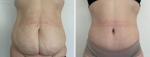 Abdominoplasty (Tummy Tuck) before and after images, patient 50, front view