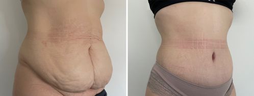 Abdominoplasty (Tummy Tuck) images, patient 50, angle view, surgery results