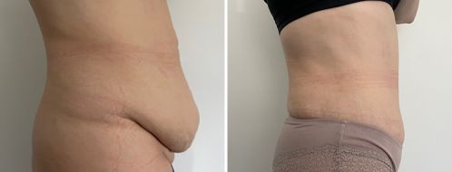 Tummy Tuck Photos 119 Abdominoplasty (Tummy Tuck) images, patient 50, side view, surgery results