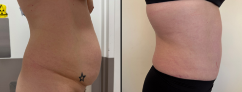 Tummy Tuck Photos 1 Abdominoplasty (Tummy Tuck) before and after images, side view, surgery results, post-op 19 months, client 47
