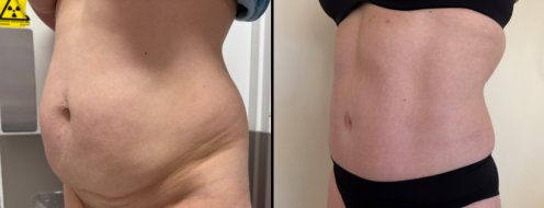 Tummy Tuck Photos 3 Abdominoplasty (Tummy Tuck) before and after images, angle view, surgery results, post-op 19 months, client 47