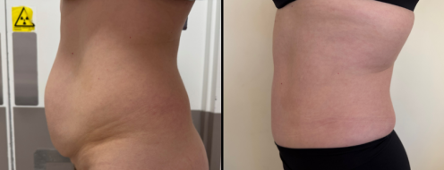 Tummy Tuck Photos 4 Abdominoplasty (Tummy Tuck) before and after images, side view, surgery results, post-op 19 months, client 47