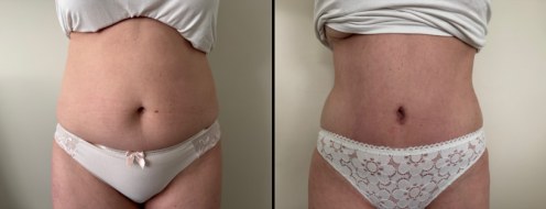 Tummy Tuck Photos 5 Abdominoplasty (Tummy Tuck) before and after images, front view, surgery results, post-op 3 months, client 48