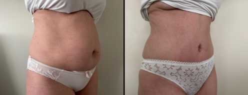 Tummy Tuck Photos 6 Abdominoplasty (Tummy Tuck) before and after images, angle view, surgery results, post-op 3 months, client 48
