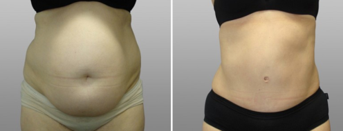 Abdominoplasty patient 1, front view, before & after surgery image