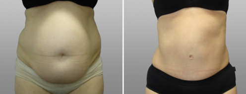 Tummy Tuck Photos 113 Abdominoplasty (Tummy Tuck) patient 1, front view, before and after photos post-op 6 weeks