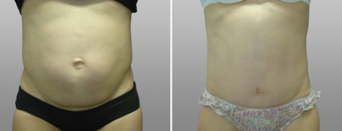 Abdominoplasty surgery, front view, patient 10, image gallery