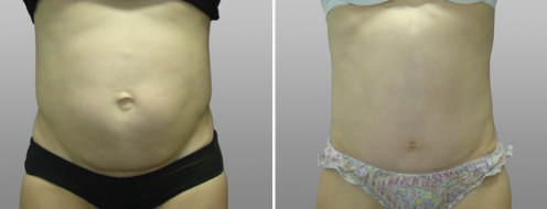 Tummy Tuck Photos 104 Abdominoplasty (Tummy Tuck) surgery, front view, patient 10,before and after photos post-op 6 weeks