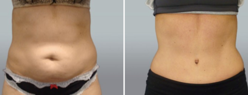 Tummy Tuck Photos 14 Abdominoplasty (Tummy Tuck) before and after photos post-op 6 weeks, patient 44, front