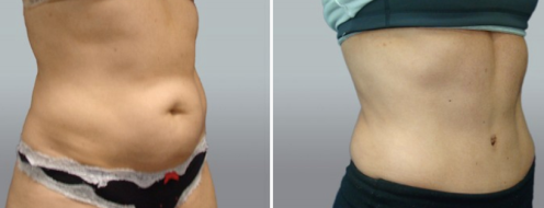 Tummy Tuck Photos 13 Abdominoplasty (Tummy Tuck) images, patient 44, angle view, before and after photos post-op 6 weeks