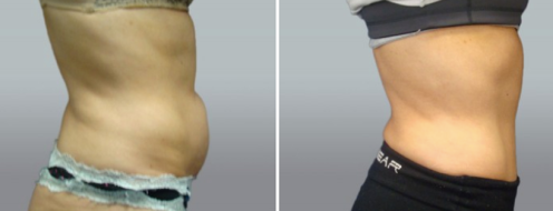 Tummy Tuck Photos 12 Abdominoplasty (Tummy Tuck) before and after photos post-op 6 weeks, image 102, side view