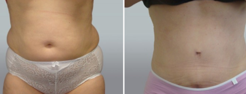 Tummy Tuck Photos 11 Abdominoplasty (Tummy Tuck) before and after photos post-op 6 weeks, patient 45, image 103, front view