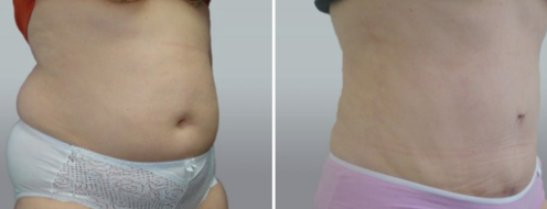 Tummy Tuck Photos 10 Abdominoplasty (Tummy Tuck) images, patient 45, angle view, surgery results, before and after photos post-op 6 weeks