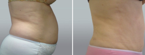Tummy Tuck Photos 9 Patient 45, Abdominoplasty (Tummy Tuck) before and after photos post-op 6 weeks, image 105, side view