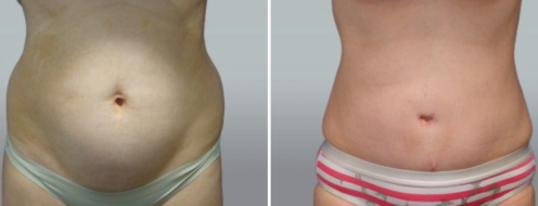Abdominoplasty (Tummy Tuck) images, patient 46 before & after surgery image 106, front view